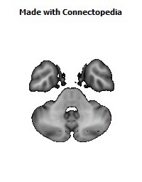 Posterior_thalamic_radiation_R144