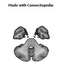 Posterior_thalamic_radiation_R146