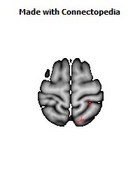 Posterior_thalamic_radiation_R042