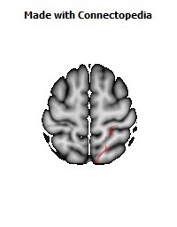 Posterior_thalamic_radiation_R048