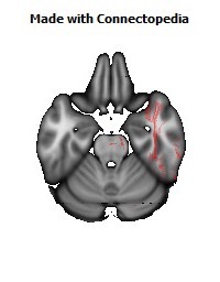 Retrolenticular_part_of_internal_capsule_R132