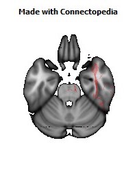 Retrolenticular_part_of_internal_capsule_R134