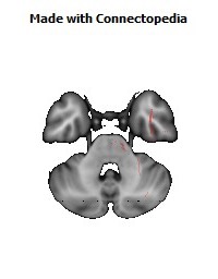 Retrolenticular_part_of_internal_capsule_R142