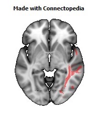 Sagittal_stratum_R112