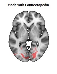 Splenium_of_corpus_callosum108