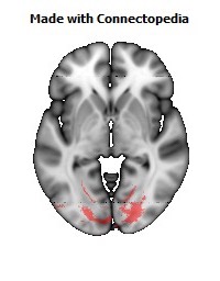 Splenium_of_corpus_callosum110