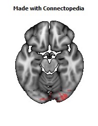 Splenium_of_corpus_callosum124