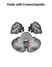 Superior_cerebellar_peduncle_R144