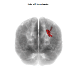 Superior Fronto-Occipital Fasciculus