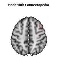 Superior_fronto-occipital_fasciculus_R060