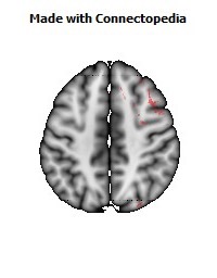 Superior_fronto-occipital_fasciculus_R062