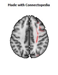 Superior_fronto-occipital_fasciculus_R066