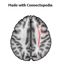 Superior_fronto-occipital_fasciculus_R068