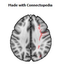 Superior_fronto-occipital_fasciculus_R072