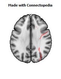 Superior_fronto-occipital_fasciculus_R076