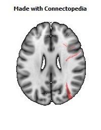 Superior_fronto-occipital_fasciculus_R082