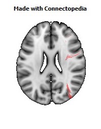 Superior_fronto-occipital_fasciculus_R084