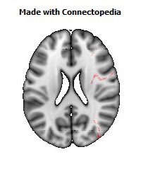 Superior_fronto-occipital_fasciculus_R086