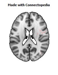 Superior_fronto-occipital_fasciculus_R088