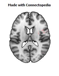 Superior_fronto-occipital_fasciculus_R092