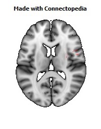 Superior_fronto-occipital_fasciculus_R094