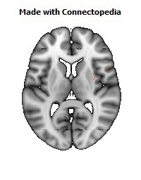 Superior_fronto-occipital_fasciculus_R098