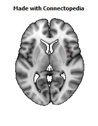 Superior_fronto-occipital_fasciculus_R102