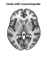 Superior_fronto-occipital_fasciculus_R104