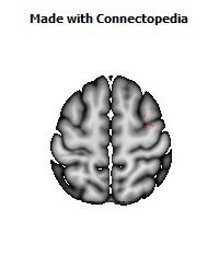 Superior_fronto-occipital_fasciculus_R050