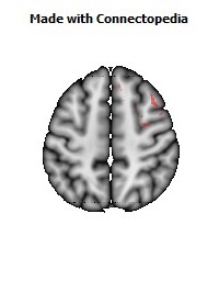 Superior_fronto-occipital_fasciculus_R058