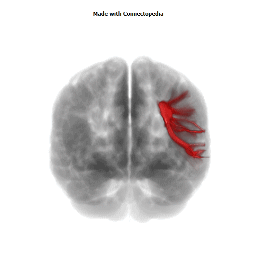 Superior Longitudinal Fasciculus