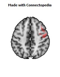 Superior_longitudinal_fasciculus_R062