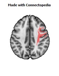 Superior_longitudinal_fasciculus_R068