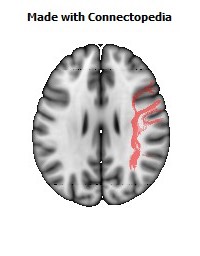 Superior_longitudinal_fasciculus_R080