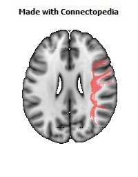 Superior_longitudinal_fasciculus_R082