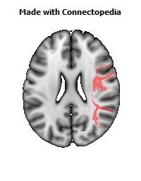 Superior_longitudinal_fasciculus_R084