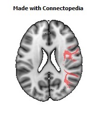 Superior_longitudinal_fasciculus_R086