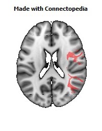 Superior_longitudinal_fasciculus_R088