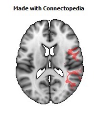 Superior_longitudinal_fasciculus_R092