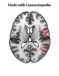 Superior_longitudinal_fasciculus_R094