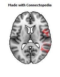 Superior_longitudinal_fasciculus_R096