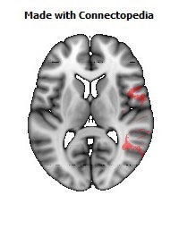 Superior_longitudinal_fasciculus_R098