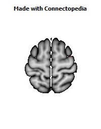 Superior_longitudinal_fasciculus_R046