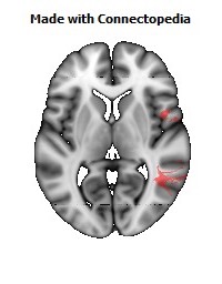 Superior_longitudinal_fasciculus_R102