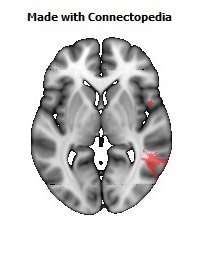 Superior_longitudinal_fasciculus_R106