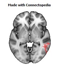 Superior_longitudinal_fasciculus_R110