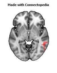 Superior_longitudinal_fasciculus_R112