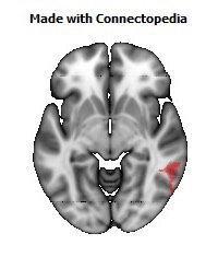 Superior_longitudinal_fasciculus_R114