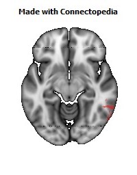 Superior_longitudinal_fasciculus_R118