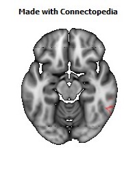 Superior_longitudinal_fasciculus_R122